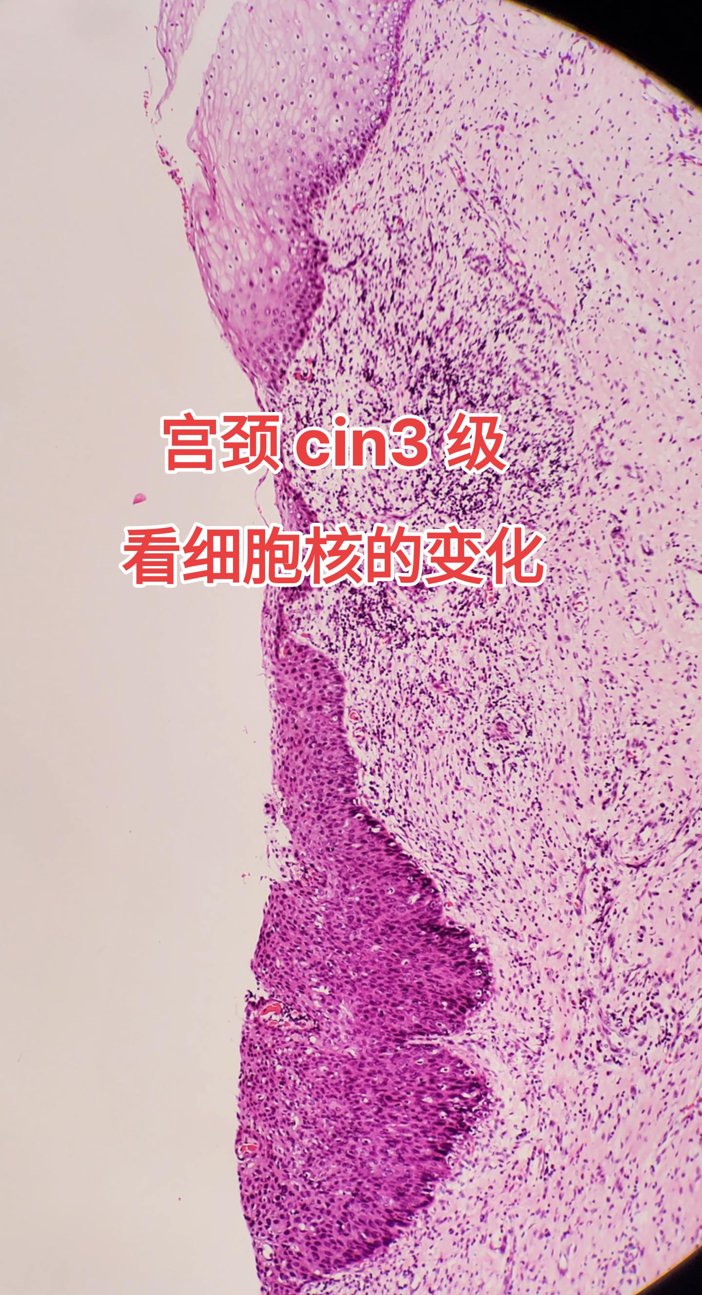hpv感染