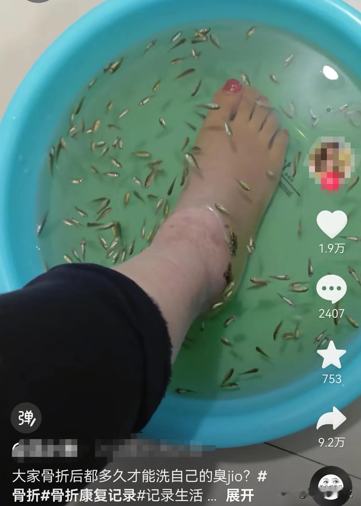 两个月没洗脚，连鱼都遭不住了！

江苏，一女生外出的时候，不小心给脚摔骨折了，一