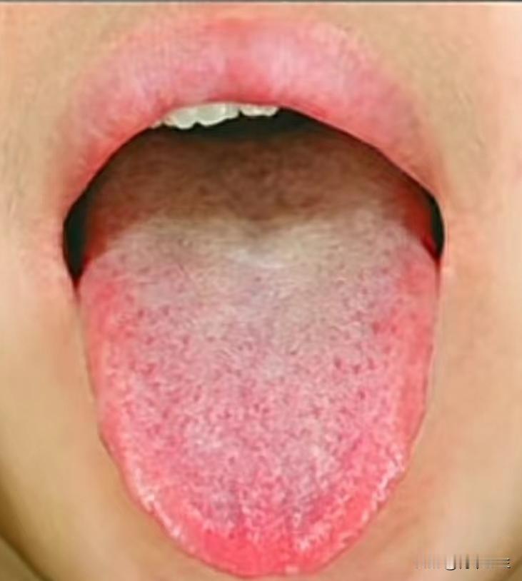 有种火气叫做肝火炽盛，每天头痛烦躁脾气爆，这样调理错不了

今天看诊了一位患者，
