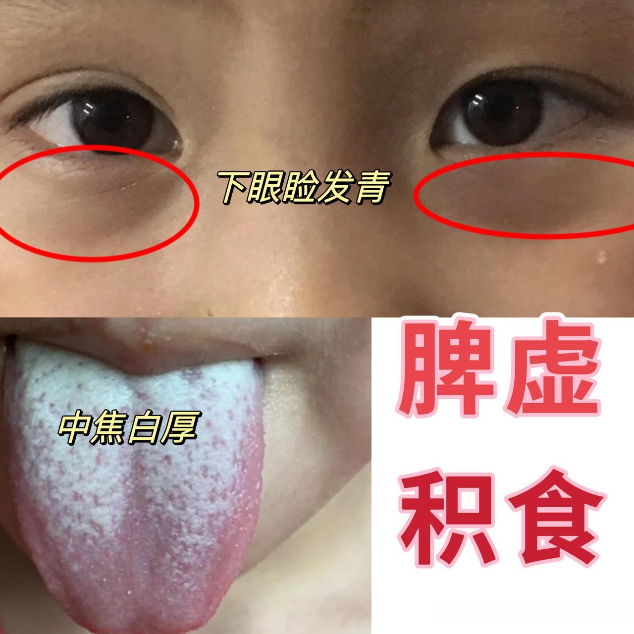 小孩经常生病，跟长期脾虚积食脱不开干系！看完这个案例你就明白了！
 
中医认为，