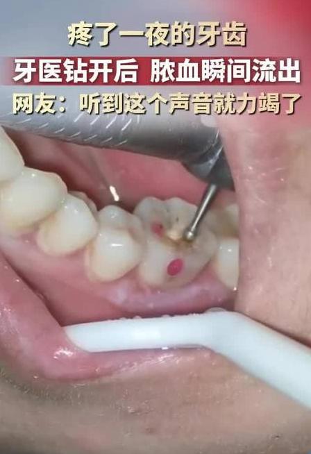 看着都疼！河南，一男子深夜突发剧烈牙痛，整整一夜被折磨得死去活来，崩溃至极。次日