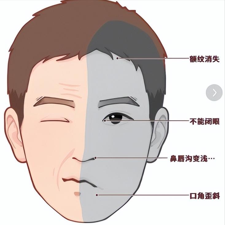 面神经损伤后还有机会吗？抓住“黄金窗口”，很多人可以更好

老张面瘫半年了，针灸