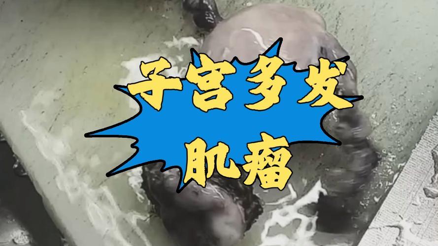 例假“渡劫”，竟揪出11cm肌瘤

女子每次来例假都痛苦不堪，如渡劫般煎熬，腹痛