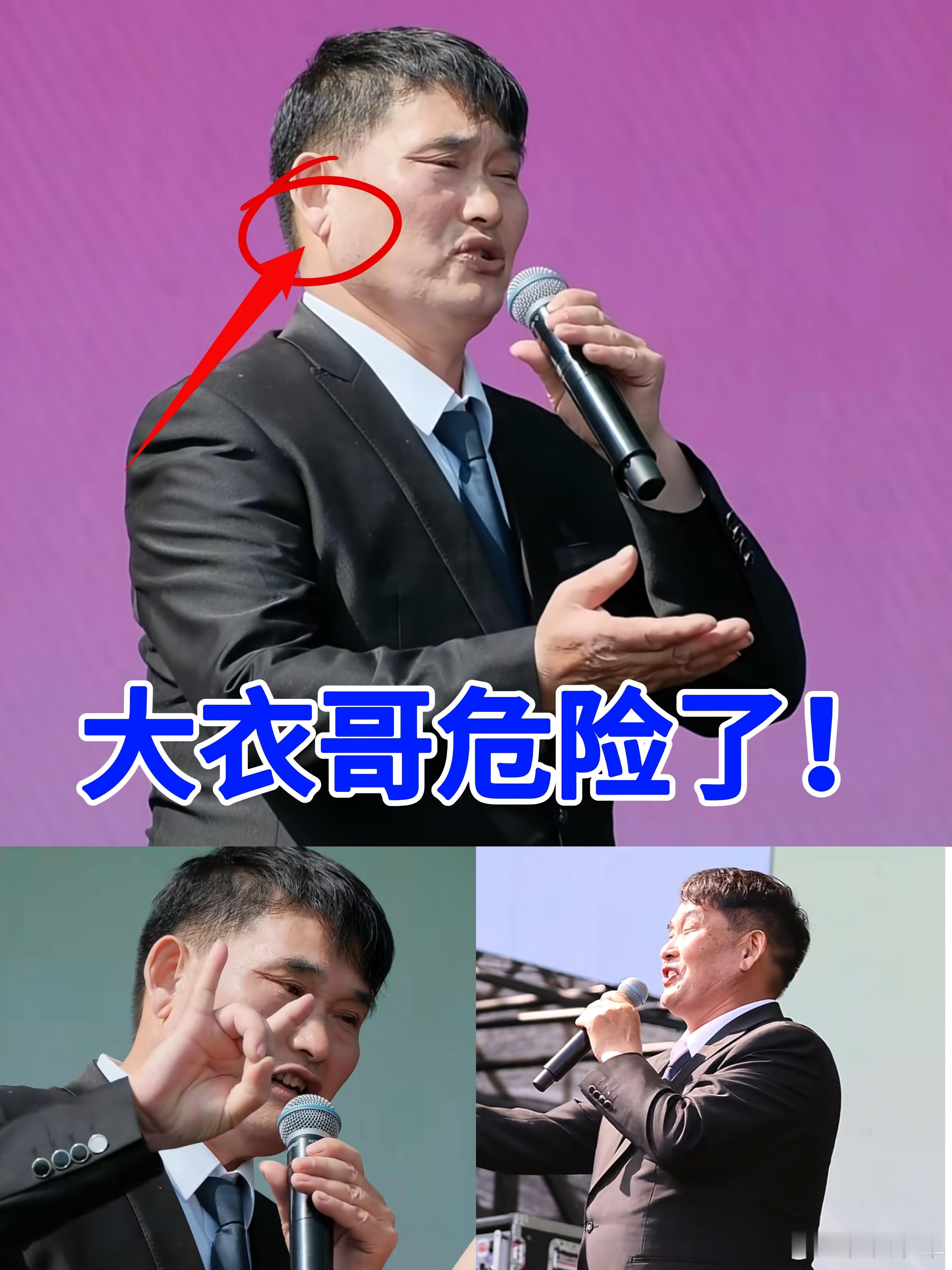 大衣哥朱之文耳朵上有深深的刻刀痕，山根有横纹，这已经是很明显的信号了，顺手整理了