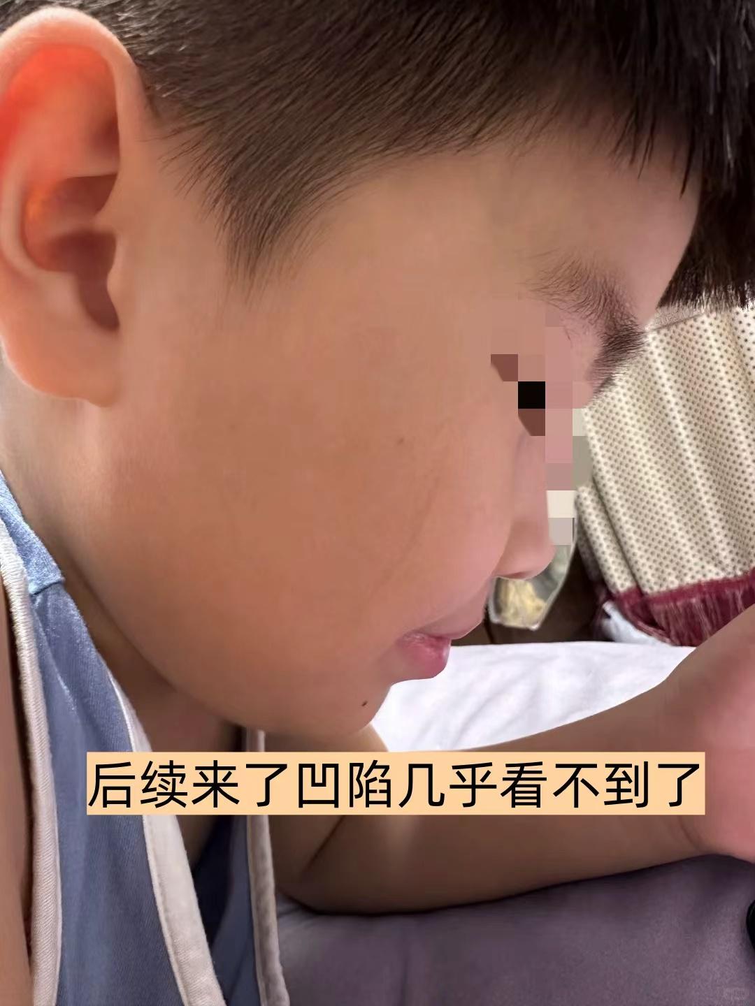 脸上疤痕后续来啦～在上海源锐疤痕纹身修复中心坚持做光电到现在，凹陷几乎...