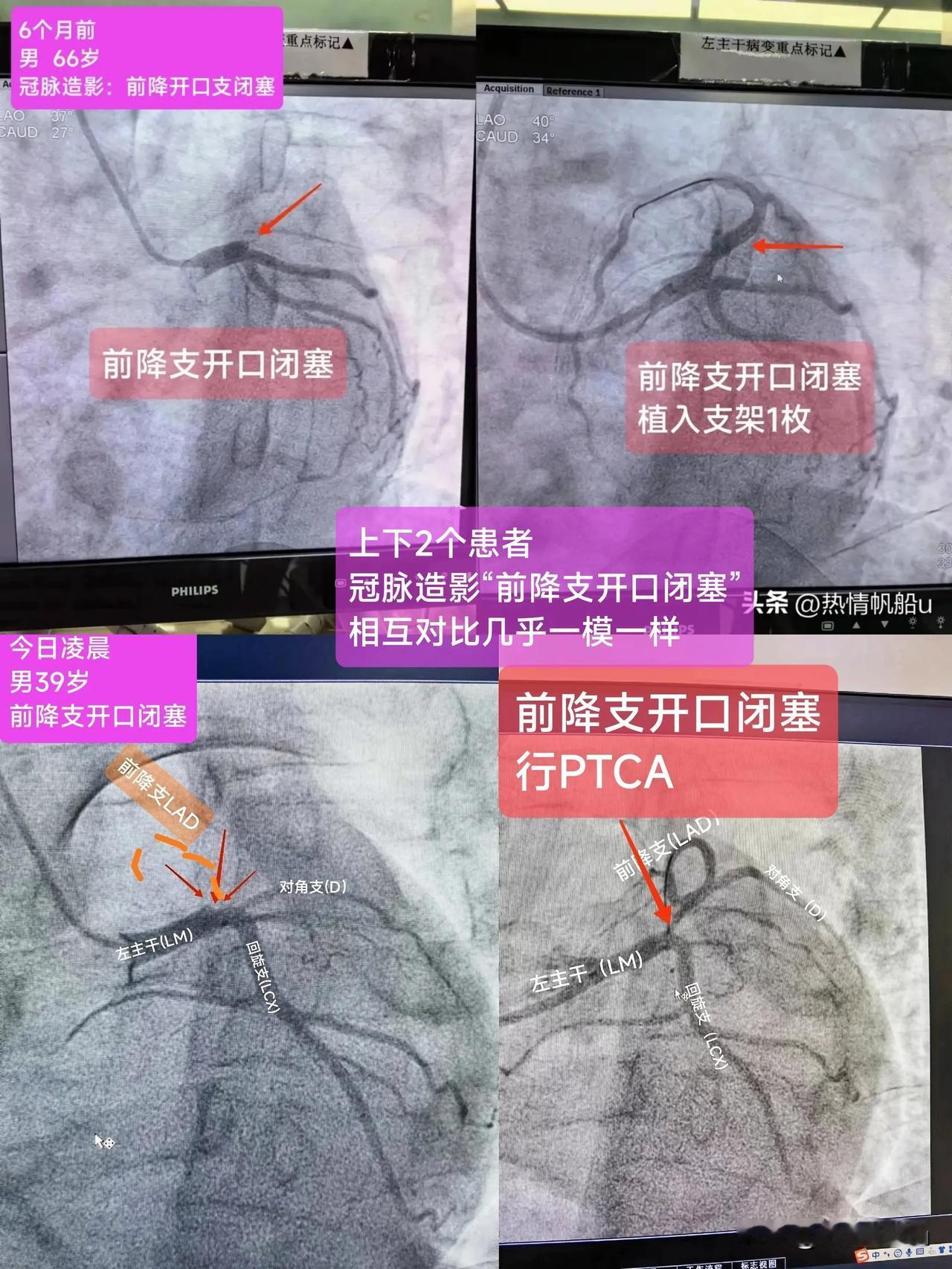 两例“急性心肌梗死”患者
1例男39岁，1例男66岁
冠脉造影和心电图表现几乎一