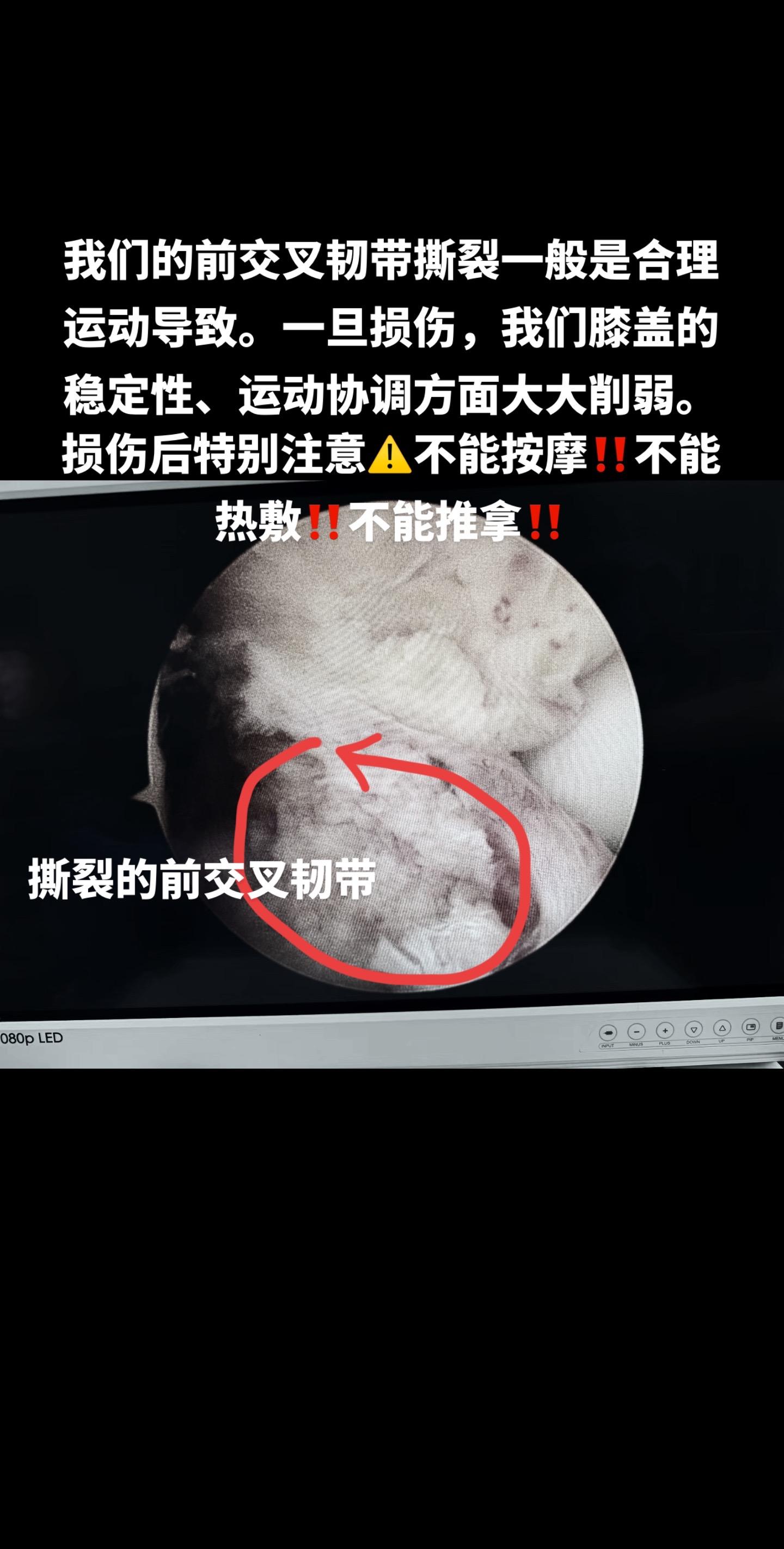 前交叉韧带重建 膝关节疼痛 运动损伤