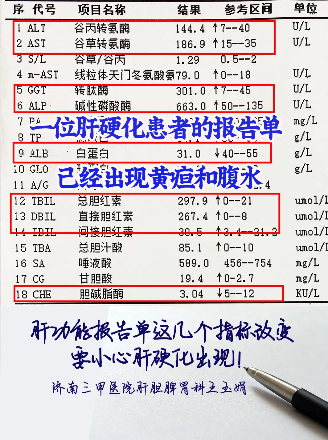 这是一位来自山东潍坊的肝硬化患者的肝功能化验单，可以看到其中有几个指标...
