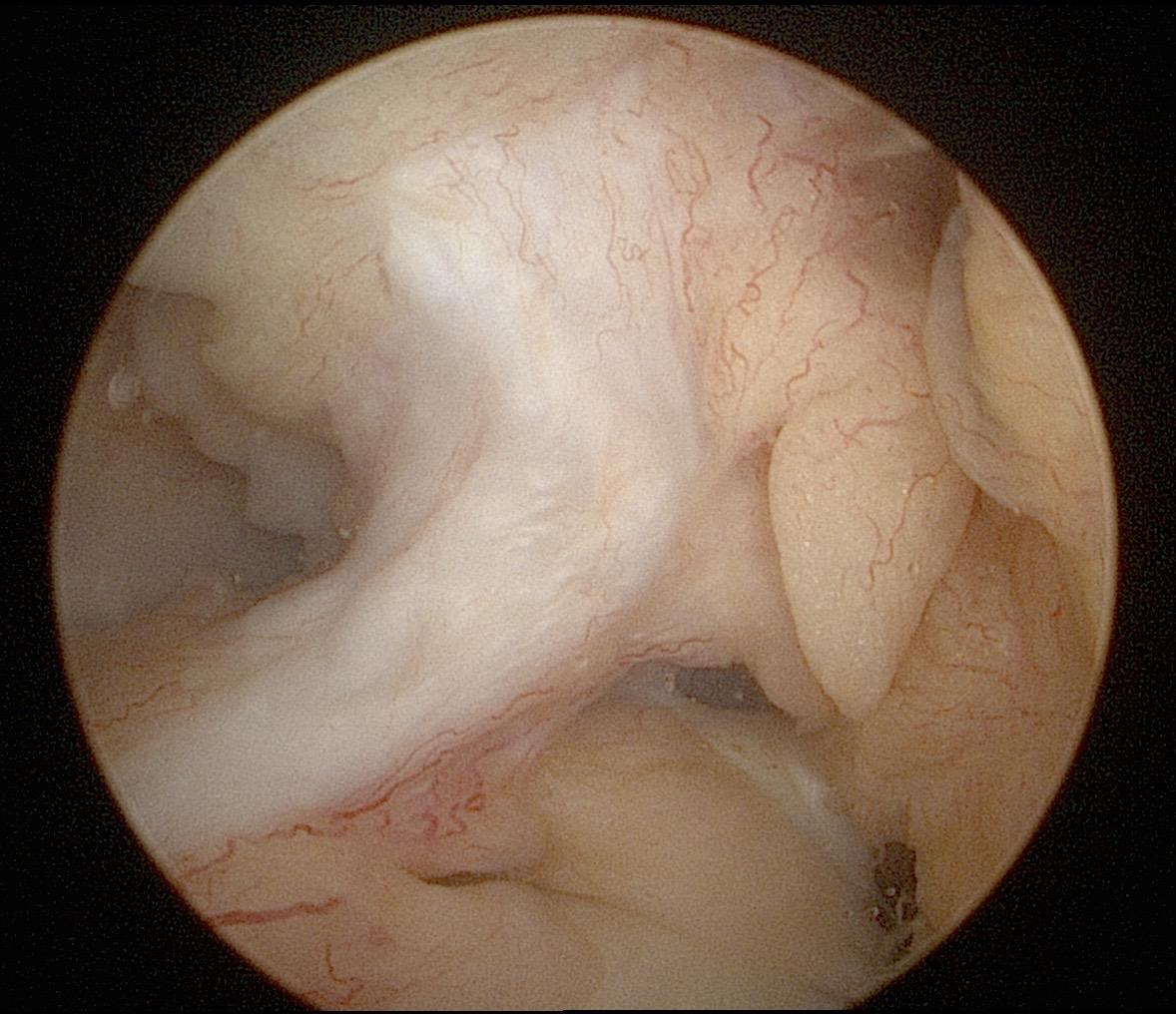 前交叉韧带重建