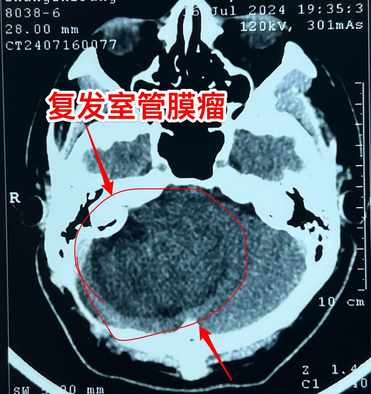 室管膜瘤是良性肿瘤还是恶性肿瘤？41岁的青海省病人，在八年前作过一次开...