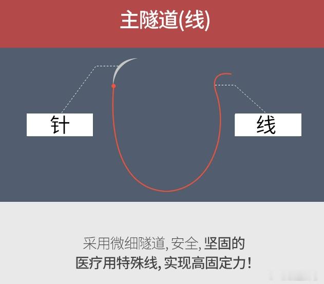 韩国额头提升的三种固定方式。其实没有最好只有适不适合。① 骨隧道固定（Bone 