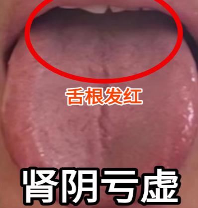 那方面能力行不行？看舌根就知道，一文分清肾虚4种类型！

（一）肾阴虚——舌根发