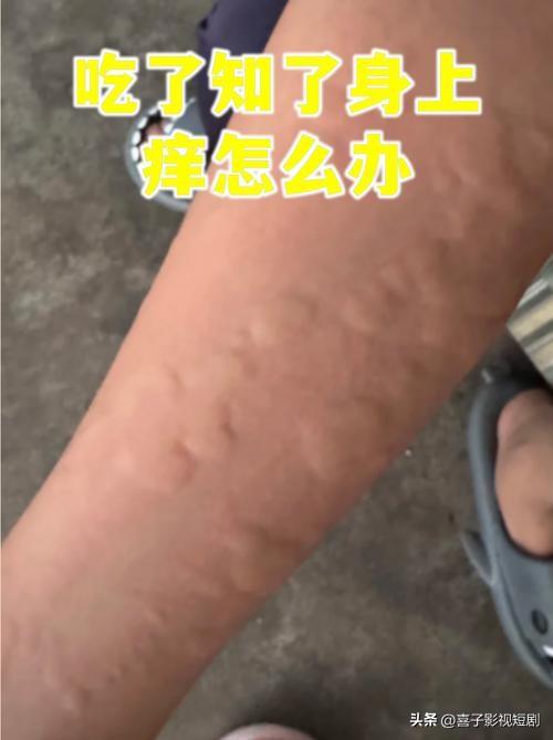 浙江永嘉的李大哥近日贪嘴，一顿吃下足足15只香酥炸知了，几小时后浑身泛起密密麻麻