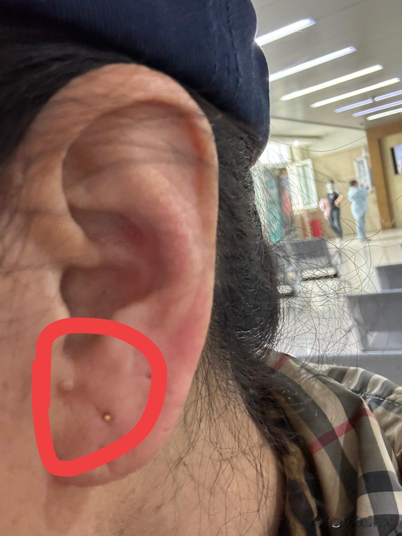 刚从医院复查回来，眼睛眼压又没问题了，也不用上药了，医生说我之前眼压有点高，大概