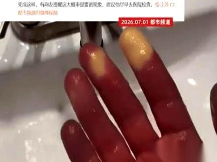 江苏一个大哥，把空调开到23度睡午觉。一睁眼，几根手指头，白得像一排蜡烛，又冷又