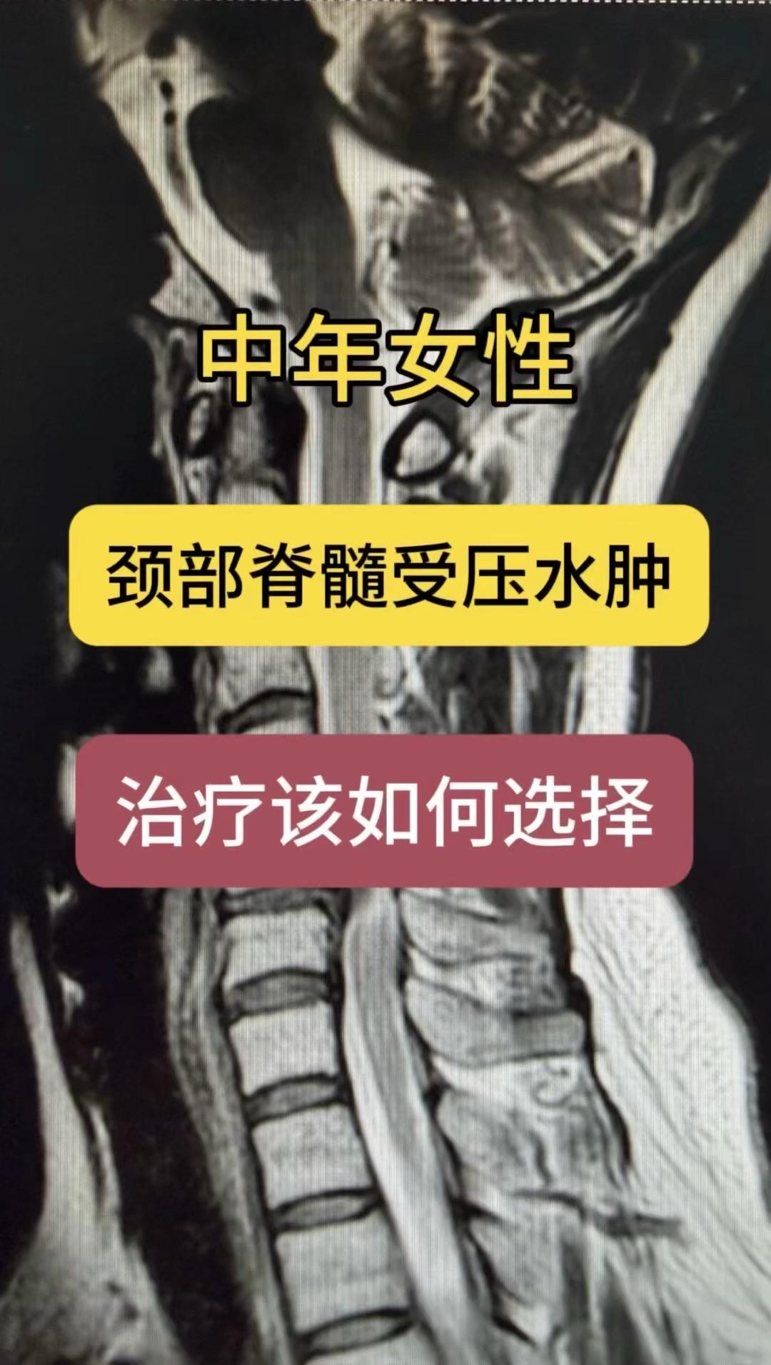 47岁女性，行走无力伴双上肢疼痛3年，加重1年。术前显示颈5/6压迫极...