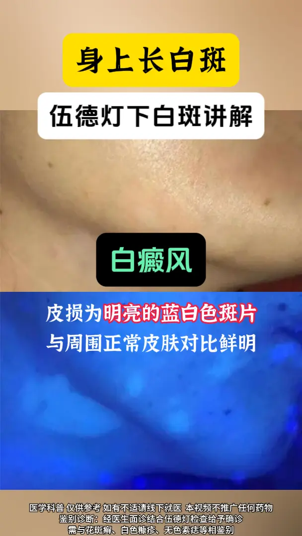 白癜风的早期是什么样子？1、白癜风的白斑不痛不痒  2、白斑摸起来和正...