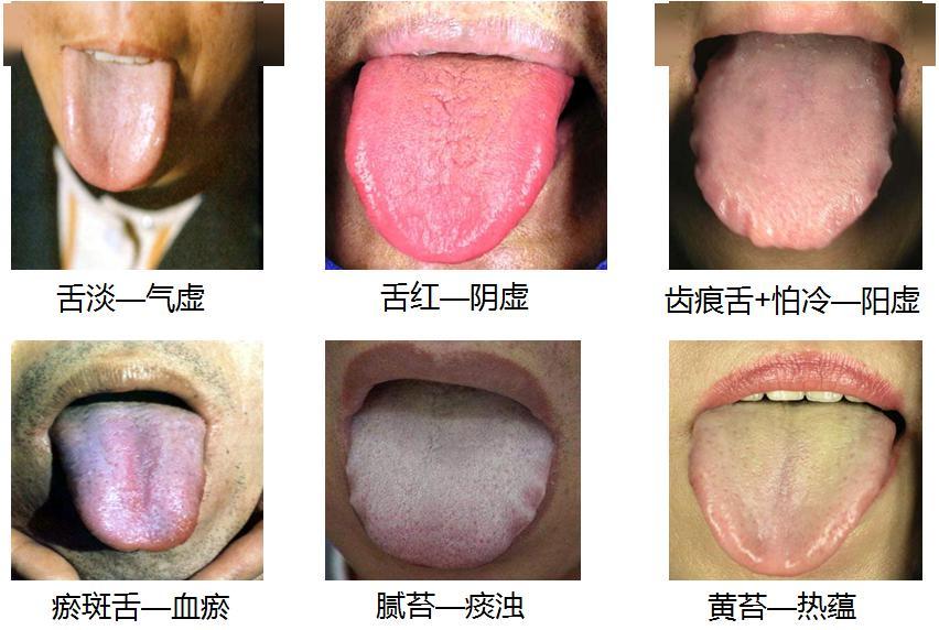 全网收集舌象，阴虚？阳虚？肝郁脾虚？湿热？上热下寒？或者脾肾双虚？一图讲明白
