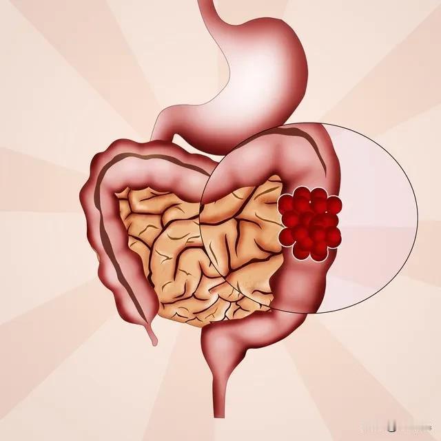 一、饮食结构失衡或致肠癌风险上升
长期食用高脂肪、高蛋白而低纤维的食物模式会极大