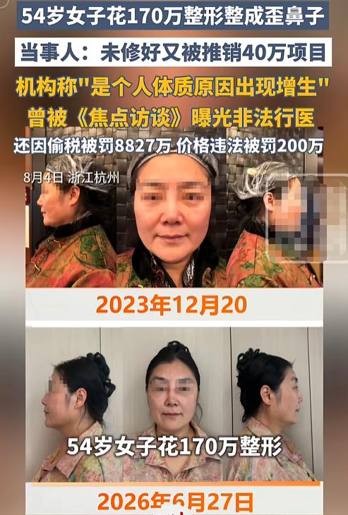 “我还怎么见人！”北京一位54岁大姐砸了170万整形，鼻子却整歪了。跑去修复，机