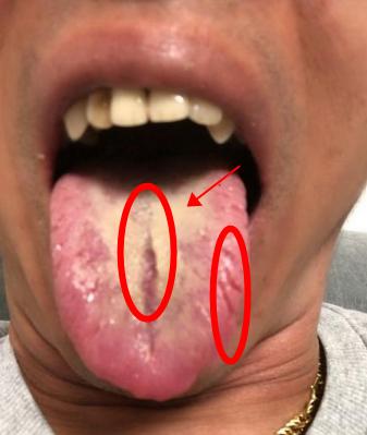 这种舌苔，一看都是 各方面不懂得节制，肝、脾、肾都被伤透了[谢谢][谢谢][谢谢