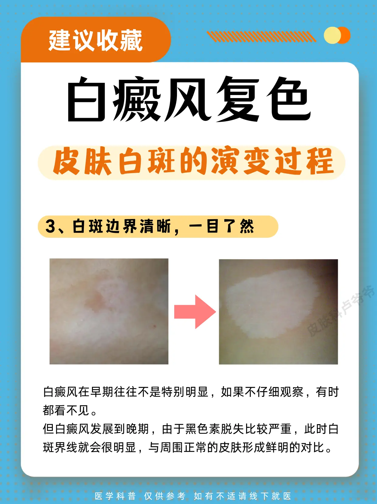 医学科普 白癜风 白癜风好了 硬核健康科普行动  白斑