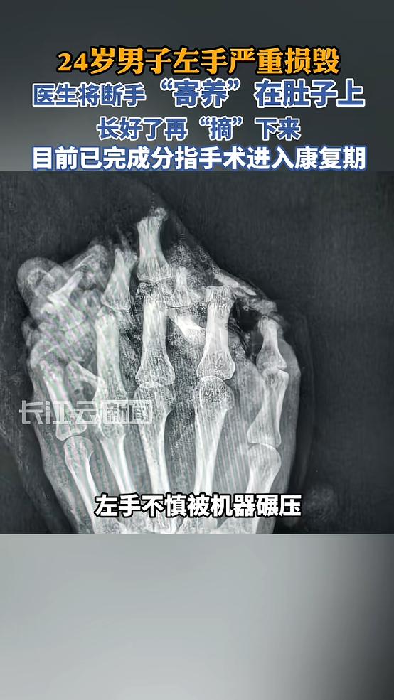 “太神奇了！”近日，广东东莞，一男子工作时，左手不慎被机器碾压，导致手被严重损伤