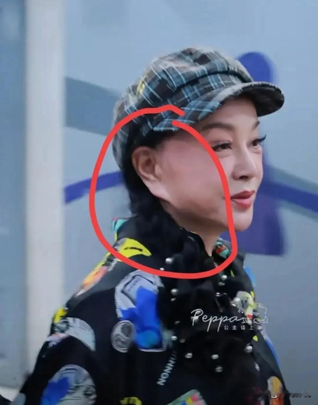 仔细看，刘晓庆的脸做了拉皮，耳朵却没作相应处理，于是产生变形，可以简称“扯歪了”