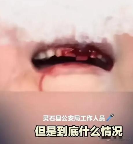 又是校园霸凌！山西晋城，小女孩在学校被同学欺负，满嘴都是血，哭着说不想去上学，可