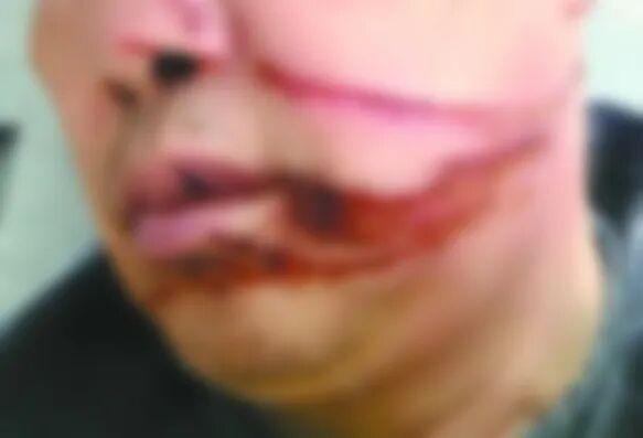 《风筝线变“割喉索”！男子骑行被割脸深可见肉，这已不是第一次》

风筝线因强度高