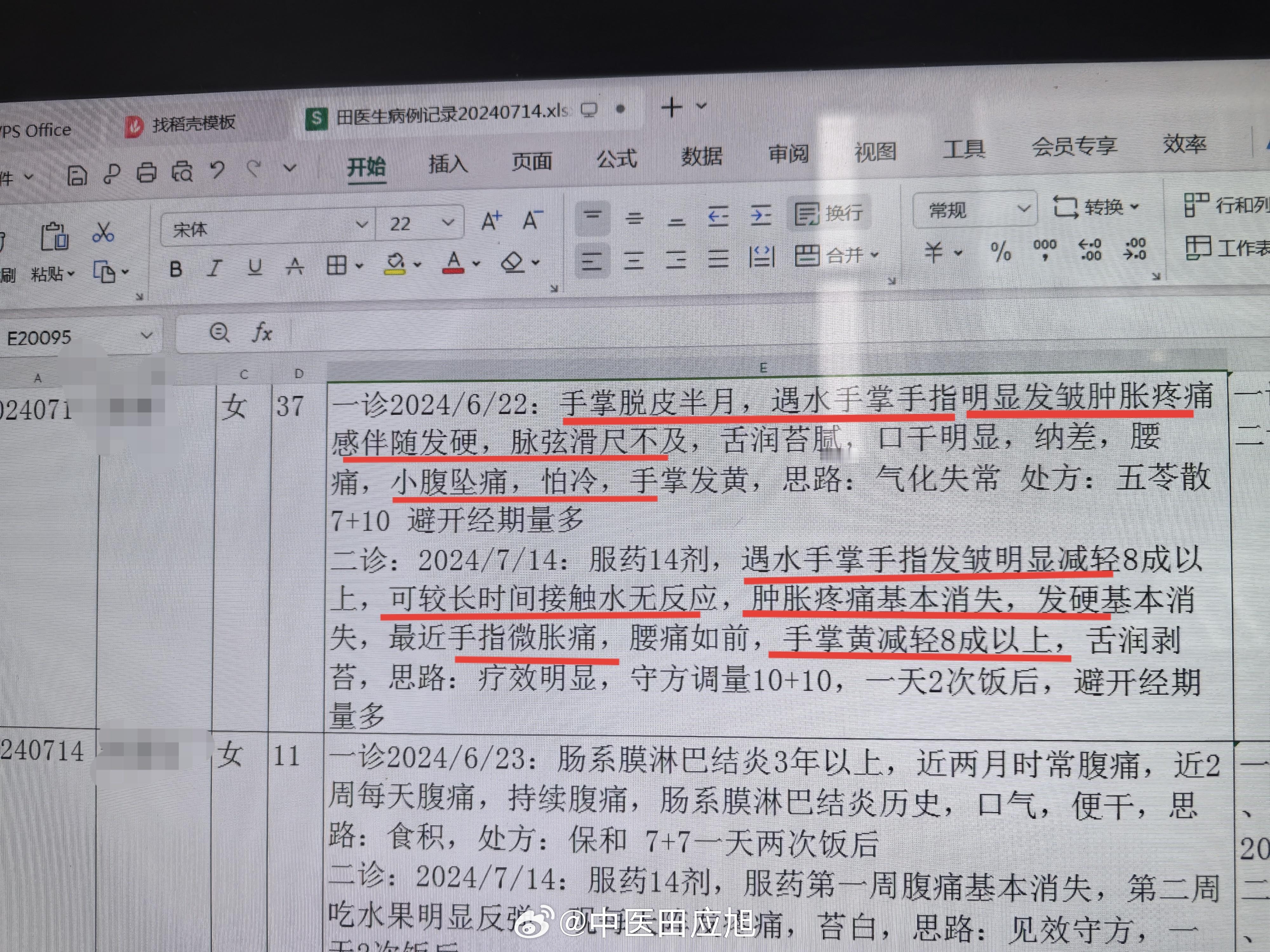 #中医#  怪怪的案子，37岁美女，近半月手指手掌遇发皱、肿胀、脱皮，伴随手指明