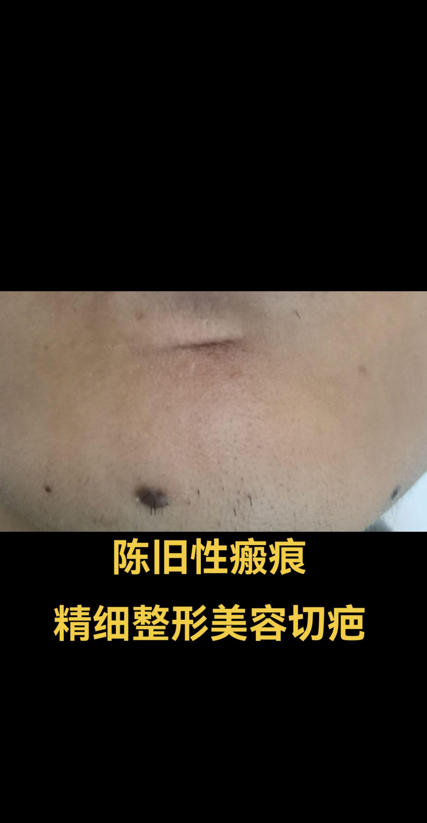 切疤。陈旧性瘢痕整形美容精细切疤。