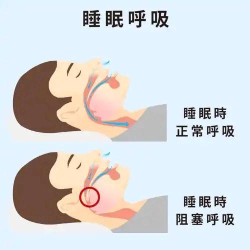 睡眠呼吸暂停低通气综合征。