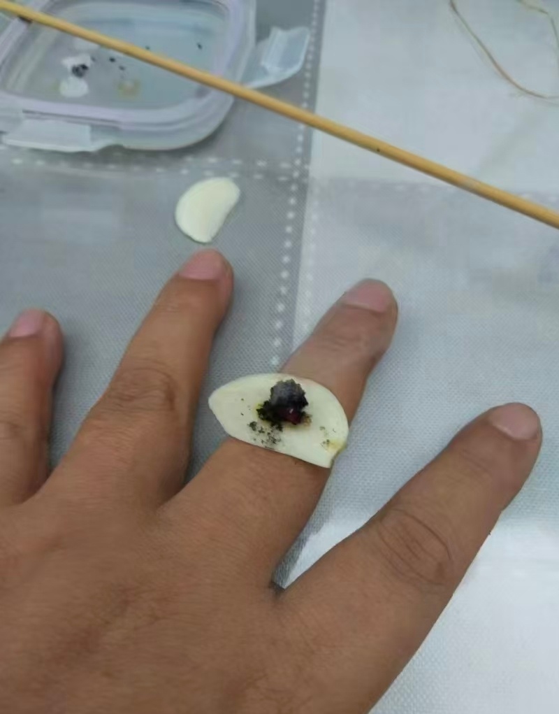 补骨脂酊下单，白癜风、扁平疣可以用。另外白癜风配合隔蒜灸，如图一次3壮，可以每天