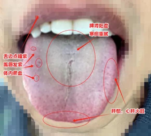 这种舌头，确实不能轻易地疏肝、健脾、补阳。尽管患者可能已经尝试了各种药物，如逍遥
