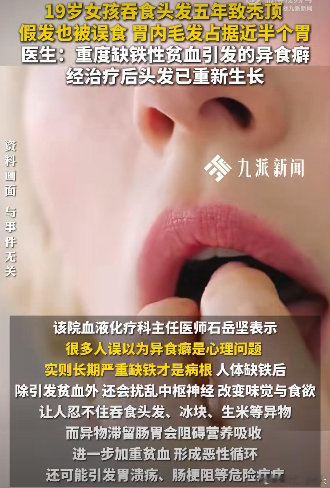 19岁女孩吞食头发占据近半个胃19岁女孩可可因长期吞食头发五年，导致秃顶且胃内堆