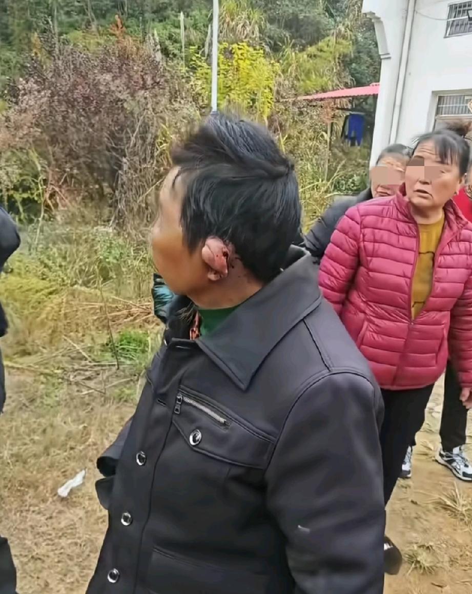 拳击运动员才有的饺子耳，没想到出现在这个被家暴几十年的农村妇女身上。

饺子耳是