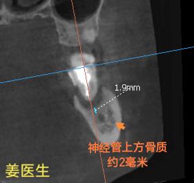 37根折，大量炎性肉芽组织，溢脓，神经管上方骨高度约2mm。处理：局麻...