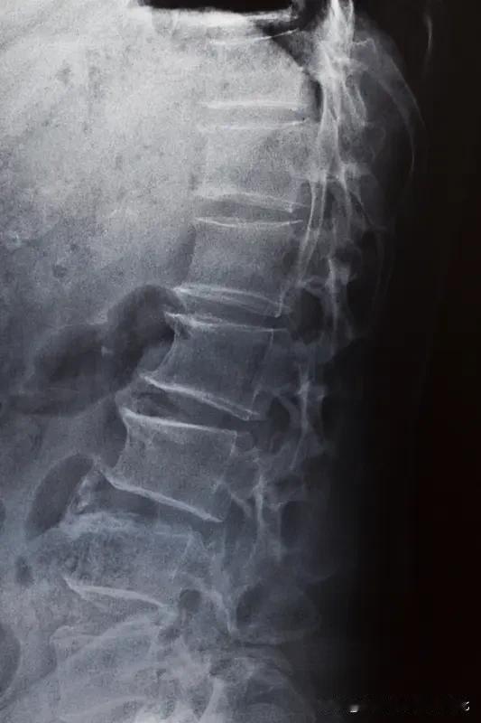 腰背部摔伤了，去医院做腰背部CT。做腰背部CT时，我准备趴着背部朝上，让CT好扫