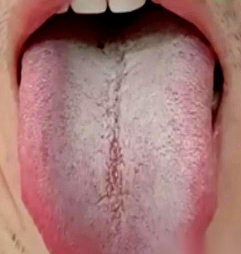 舌头中间一道大深沟，自己跑去买药吃。
结果越吃手脚越凉，越吃胃口越差，人直接蔫儿