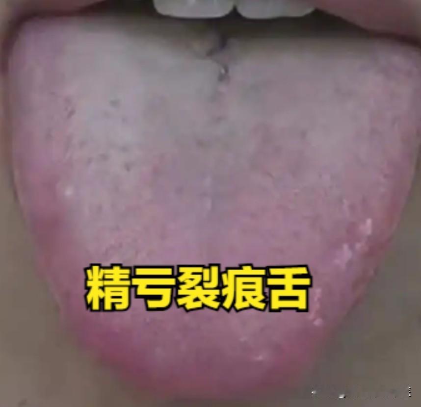 精亏裂痕舌——五子衍宗，气血虚裂痕舌——四物，阳虚裂痕舌——真武，阴虚裂痕舌——