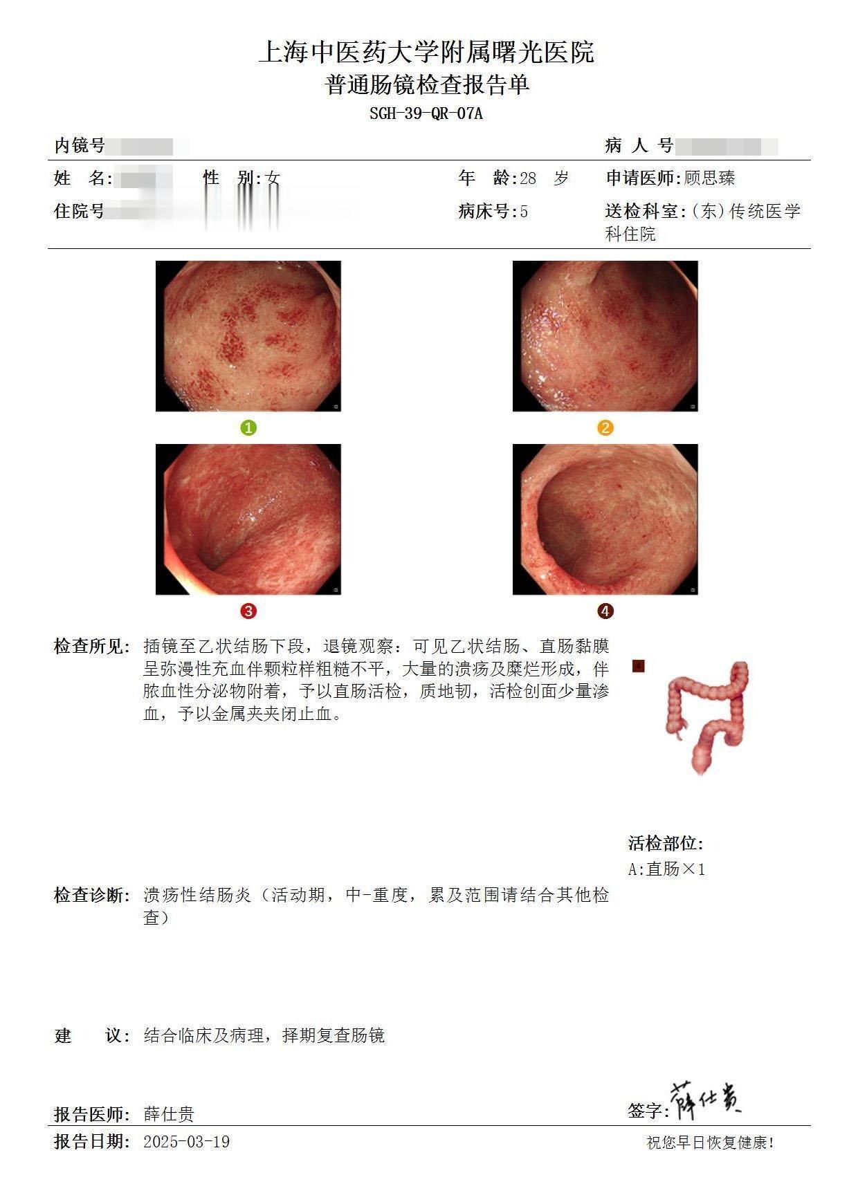 溃结治疗，最怕“试试看”心态！。这位患者 2020 年确诊溃疡性结肠炎...