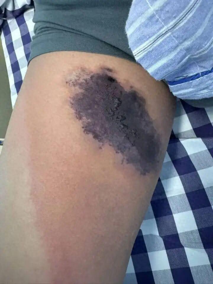 杭州一个男的换季整理衣柜，翻出一条多年没穿的牛仔裤。穿上去的时候，大腿一阵刺痛，