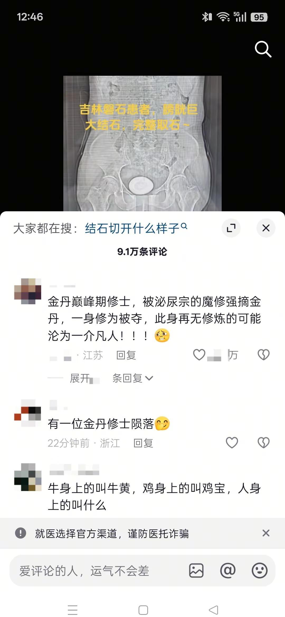 一张结石CT被网友玩出花了