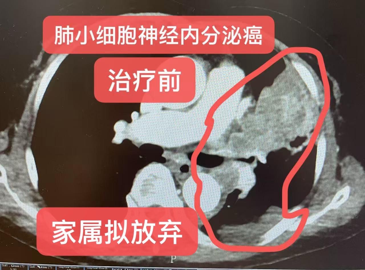 小细胞神经内分泌型肺癌（局部晚期）肺癌：穿刺病理：小细胞神经内分泌癌...