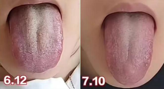 这种厚腻苔，化痰湿的同时还要化瘀，这样才能事半功倍！
来看这位粉丝的舌象：
舌苔