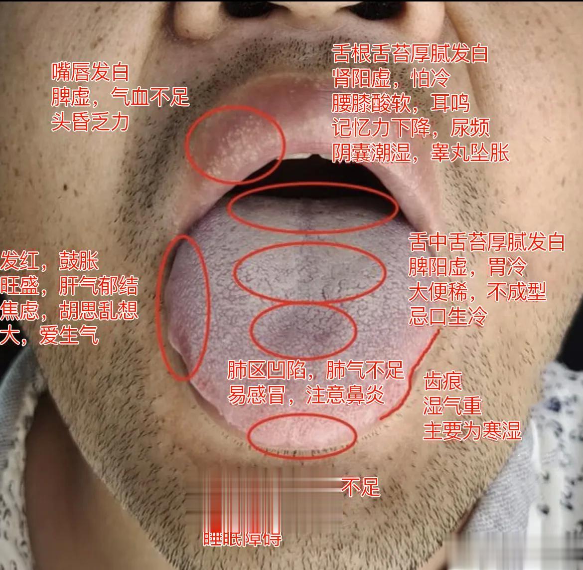 【粉丝舌象分析：心慌心悸，头晕乏力，尺寸紧缩，难起】1、舌尖发白，舌尖对应心，说
