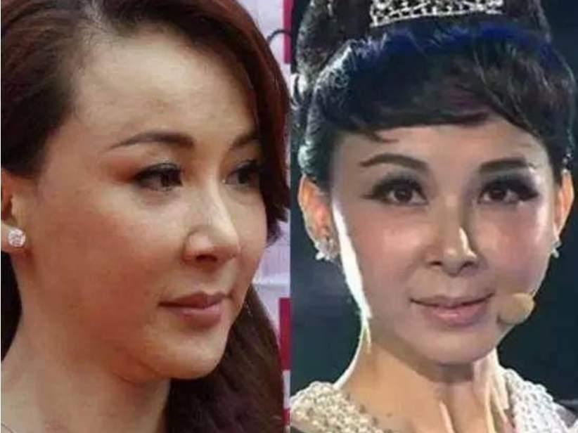 爱美之心人皆有之，医美后脸部僵硬的三位女明星，再也回不到从前的模样了