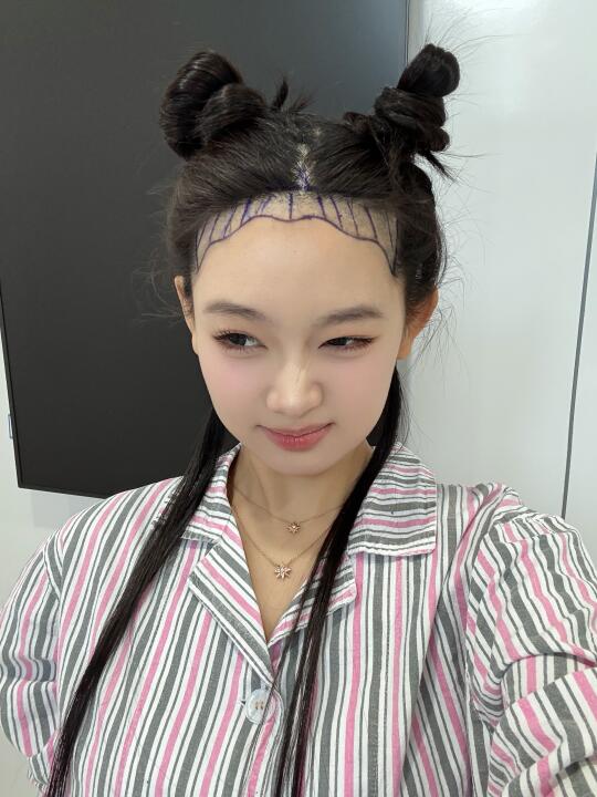 拖到了现在终于植发了!!!