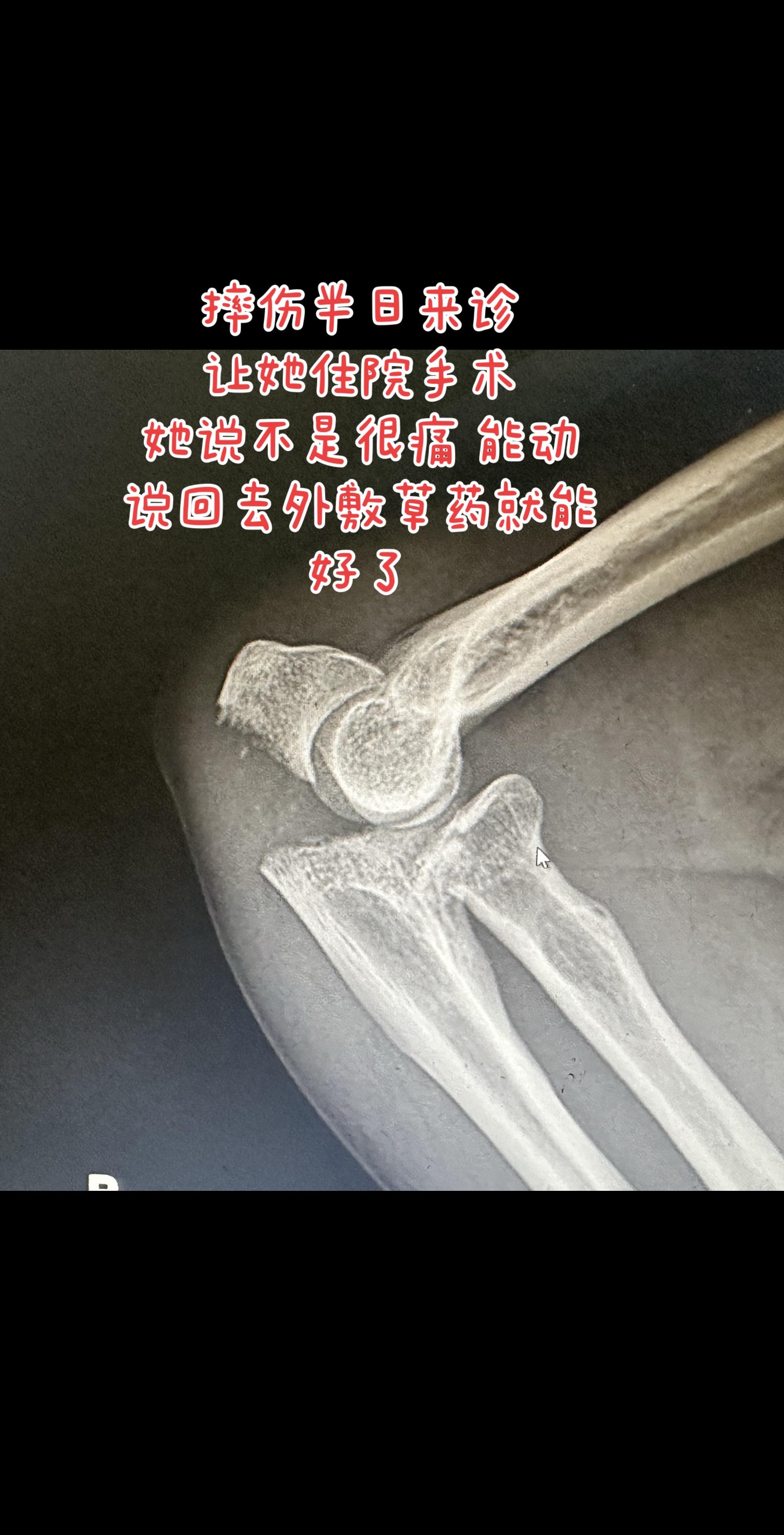 这个保守治疗能长好吗。这个分离这么远 外敷草药能长好吗